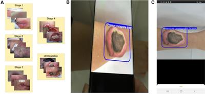 An artificial intelligence-enabled smartphone app for real-time pressure injury assessment
